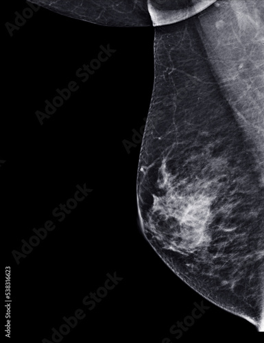 X-ray Digital Mammogram or mammography of both side breast Standard views are  mediolateral oblique (MLO) views . photo