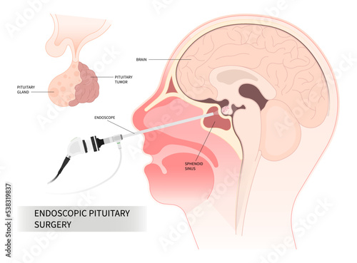 endoscopic pituitary surgery for cushing disease disorder Growth of adrenocorticotropin adrenal cortisol Transcranial Oxytocin Follicle stimulating Microadenomas and Macroadenomas anatomy photo