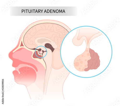 anatomy of pituitary disease surgery for cushing disorder Growth of adrenocorticotropin adrenal cortisol Transcranial Oxytocin Follicle endoscopic stimulating with Microadenomas and Macroadenomas
