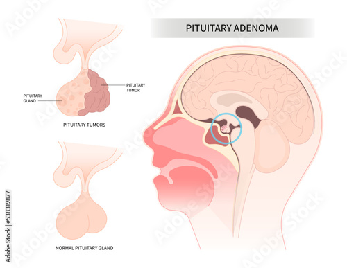 the macroadenomas anatomy of Cushing disease with endoscopic pituitary surgery disorder or Adrenocorticotropin adrenal Growth cortisol Transcranial Oxytocin Follicle stimulating Microadenomas photo