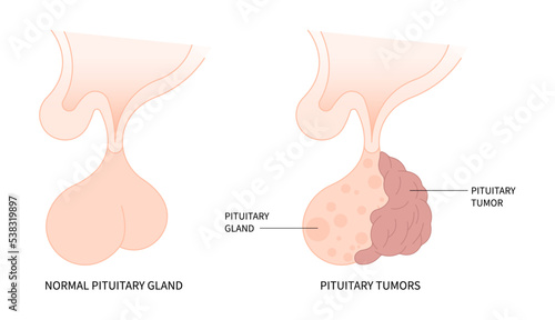 Oxytocin Follicle stimulating the adrenal cortisol with Transcranial endoscopic pituitary surgery for Cushing disease disorder Growth of Adrenocorticotropin Microadenomas and Macroadenomas anatomy