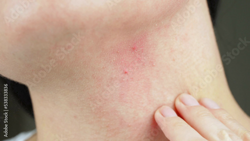 A close-up hand touches a red inflamed acne. Allergic reaction  dermatitis. Cosmetology.