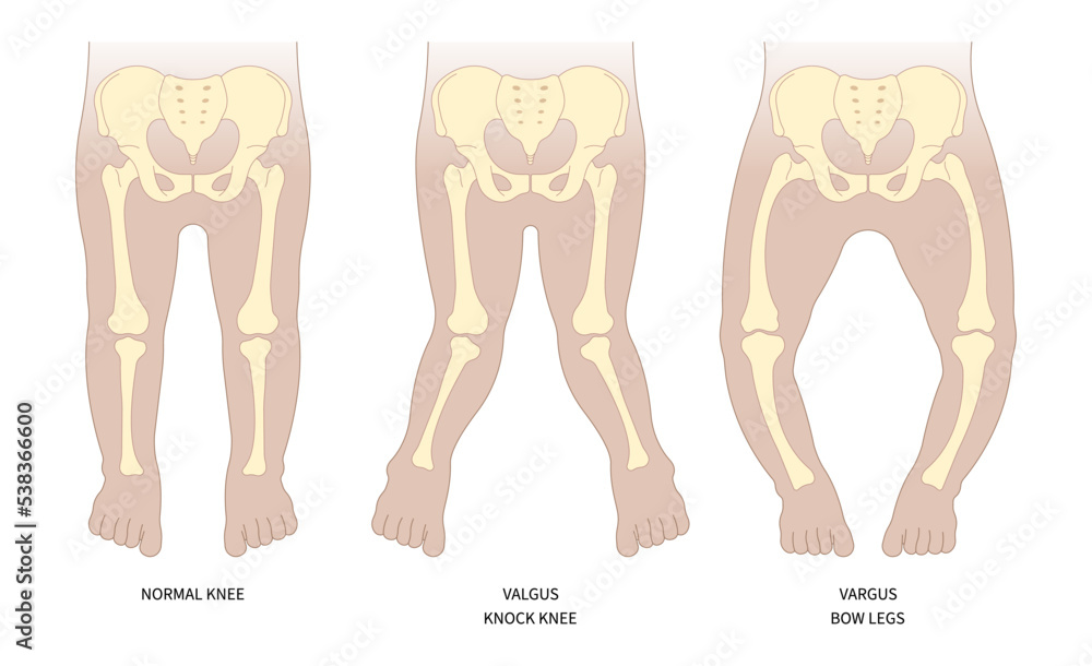 Classification Of Hip Low Density Lack Of Vitamin D With Rickets Blount classification-of-hip-low-density-lack-of-vitamin-d-with-rickets-blount