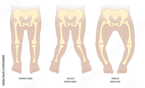 Classification of hip low density lack of vitamin D with rickets Blount's and Paget's disease x-ray