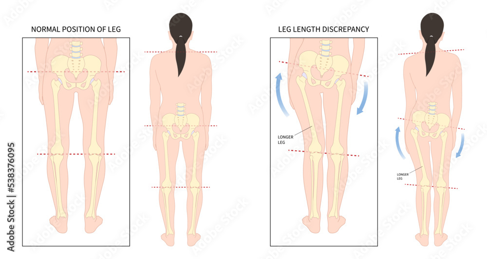 Unequal short leg length discrepancy and tilt curvature body misaligned poor postural stand High