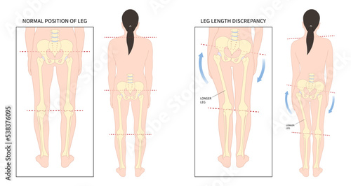 Unequal short leg length discrepancy and tilt curvature body misaligned poor postural stand High pelvis femur Limb bone tilting shoulder or toe walking ankle syndrome photo