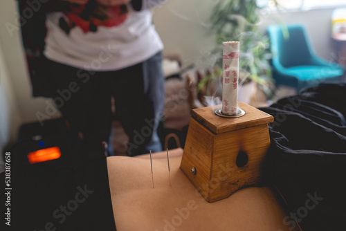 Herbal moxa stick in a smoke box over a teenager girl patient (moxibustion) with acupuncture needles in the skin and traditional chinese medicine doctor behind