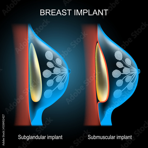 Breast implant placement comparison. x-ray blue scanning.