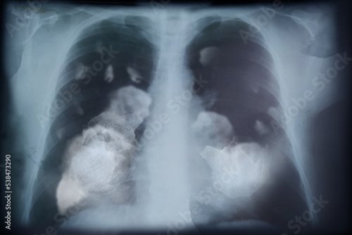 X-ray image of patient with lung cancer. Illustration © New Africa