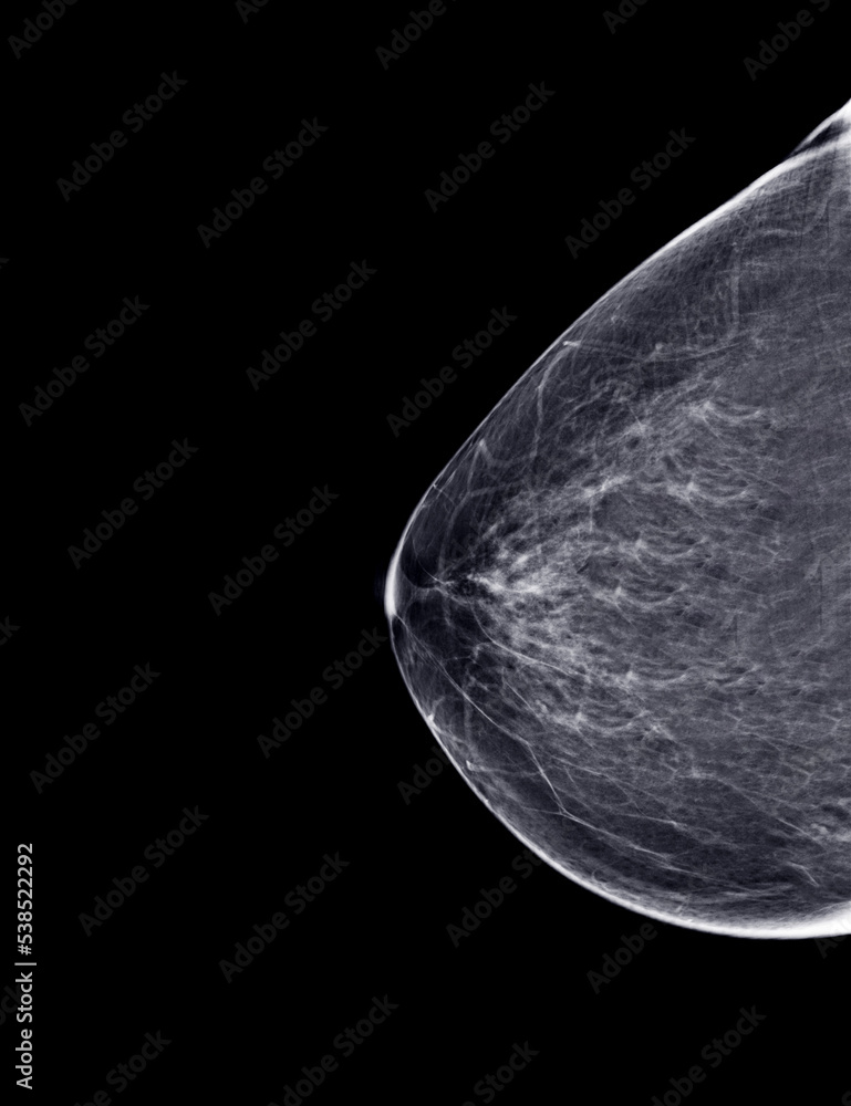 X-ray Digital Mammogram or mammography of both side breast Standard views are bilateral craniocaudal (CC) . X-ray Digital Mammogram or mammography of both side breast Standard views are bilateral craniocaudal (CC) .