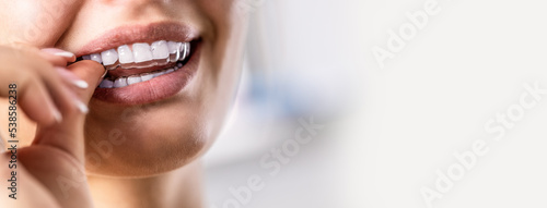 A woman puts on an invisible silicone teeth aligner. Dental braces for teeth correction photo