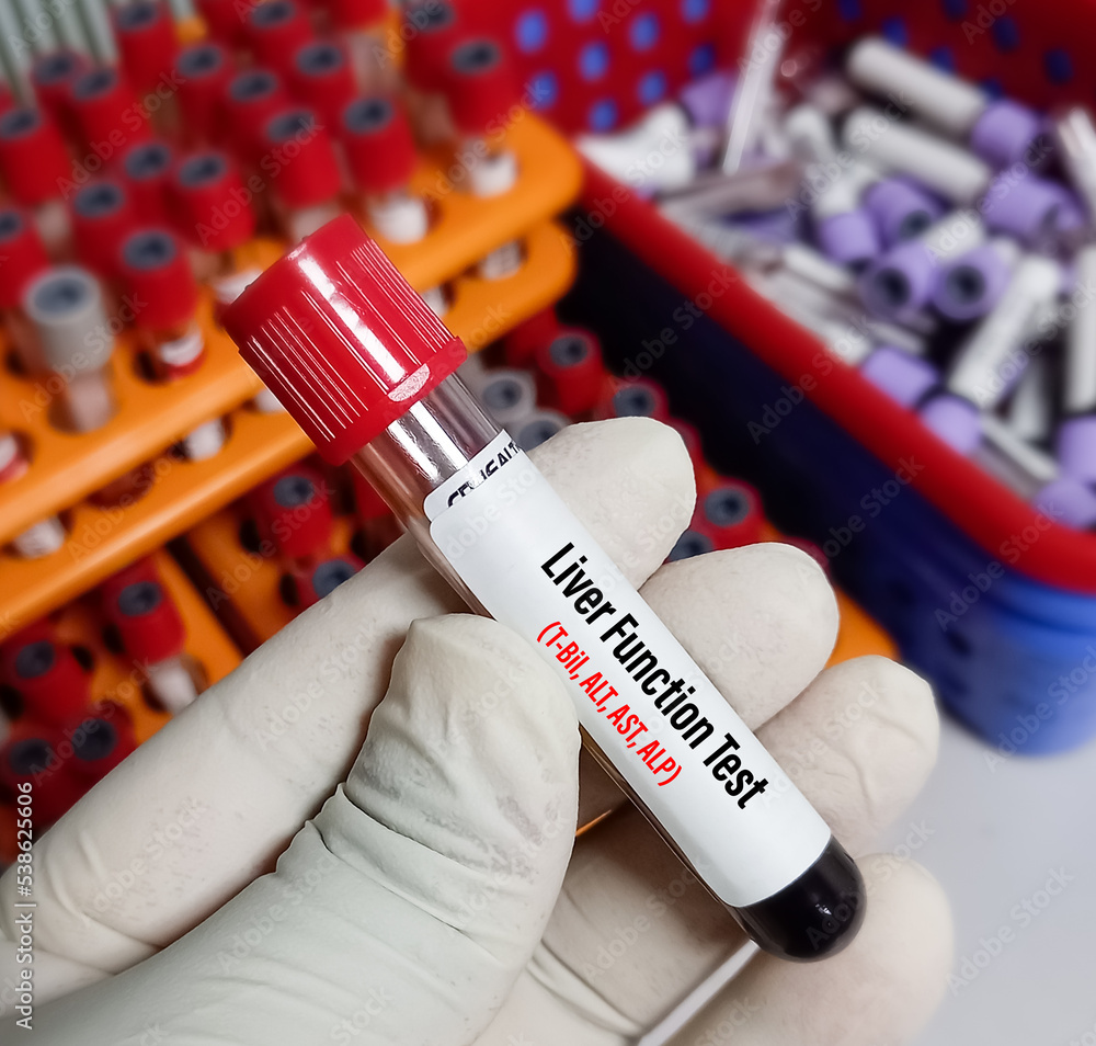 Blood sample for liver function test. ALT, AST, ALP, Total Bilirubin