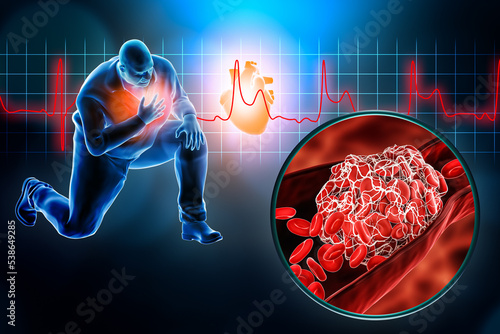 Heart stroke or attack with blood clot or thrombus and STEMI EKG 3D rendering illustration. Myocardial infarction, medicine, medical and healthcare, cardiovascular disease concepts. photo