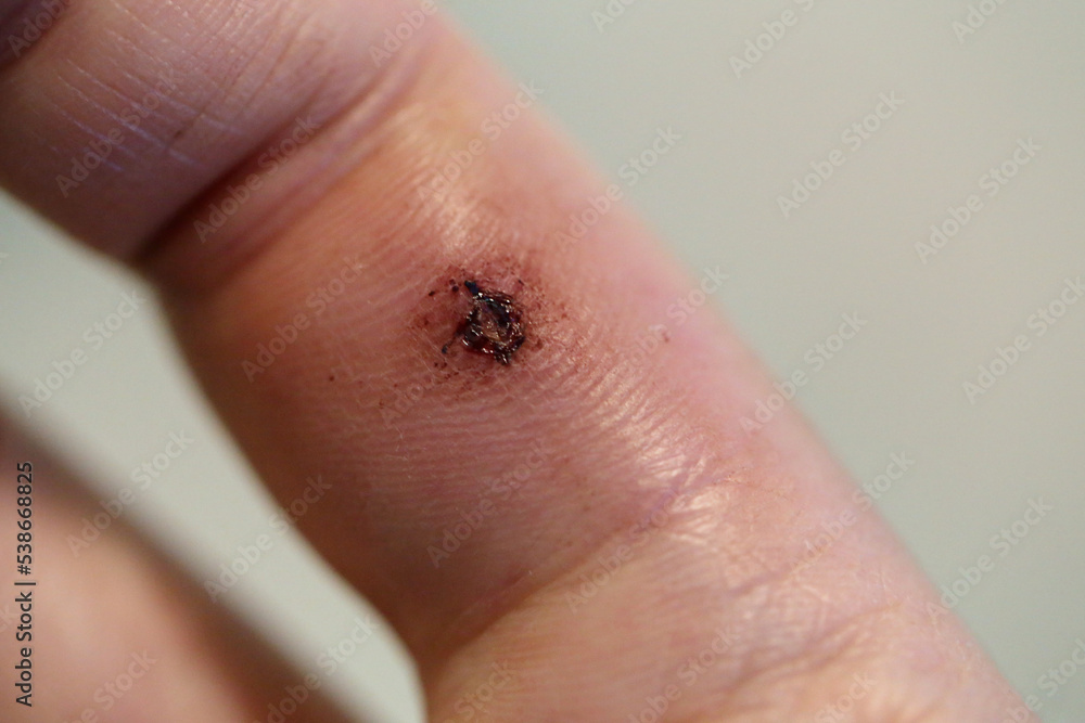 Dog bite mark on an index finger of a white woman. There is a bit