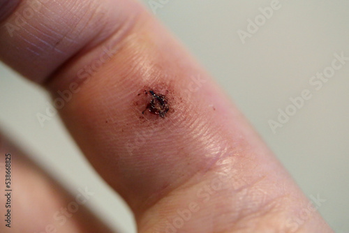 Dog bite mark on an index finger of a white woman. There is a bit swelling, redness, bruising, dry blood and beginning of a eschar. Macro medical theme photo of the wound. Closeup color image. photo