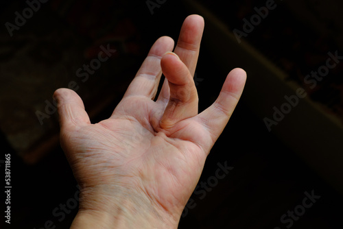 Fotobehang Hand of a person with Dupuytren's contracture, which does not allow to bend the finger