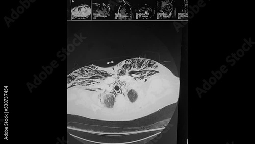 CT Chest - pneumomediastinum and subcutaneous emphysema w interstitial pneumonia photo