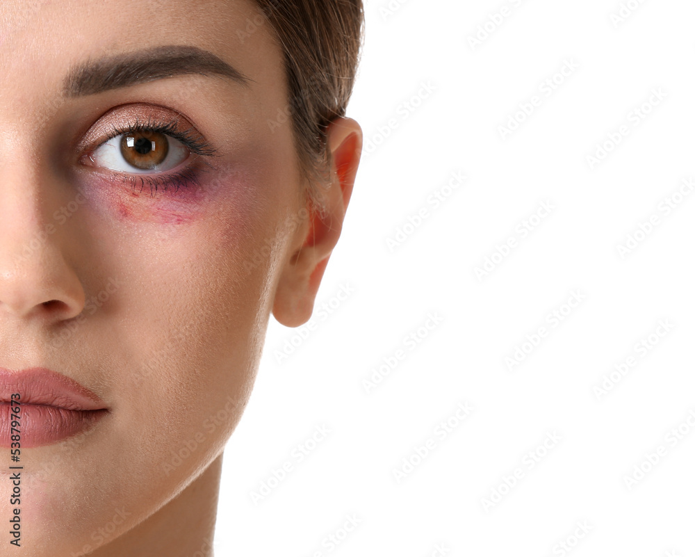 Obraz premium Young woman with bruise under eye on white background, closeup