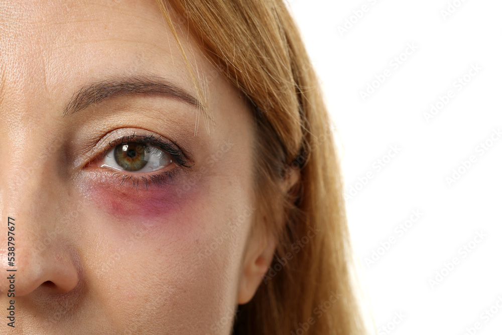 Mature woman with bruise under eye on white background, closeup Mature woman with bruise under eye on white background, closeup