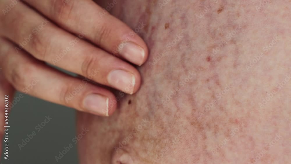 Stretch marks on the skin of a pregnant girl on her stomach, close-up Stretch marks on the skin of a pregnant girl on her stomach, close-up