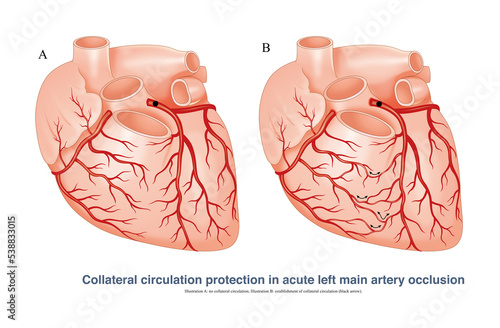 In case of acute left main stem occlusion, if the right coronary artery and left coronary artery establish collateral circulation, it can provide part of the blood to protect the left ventricular. photo