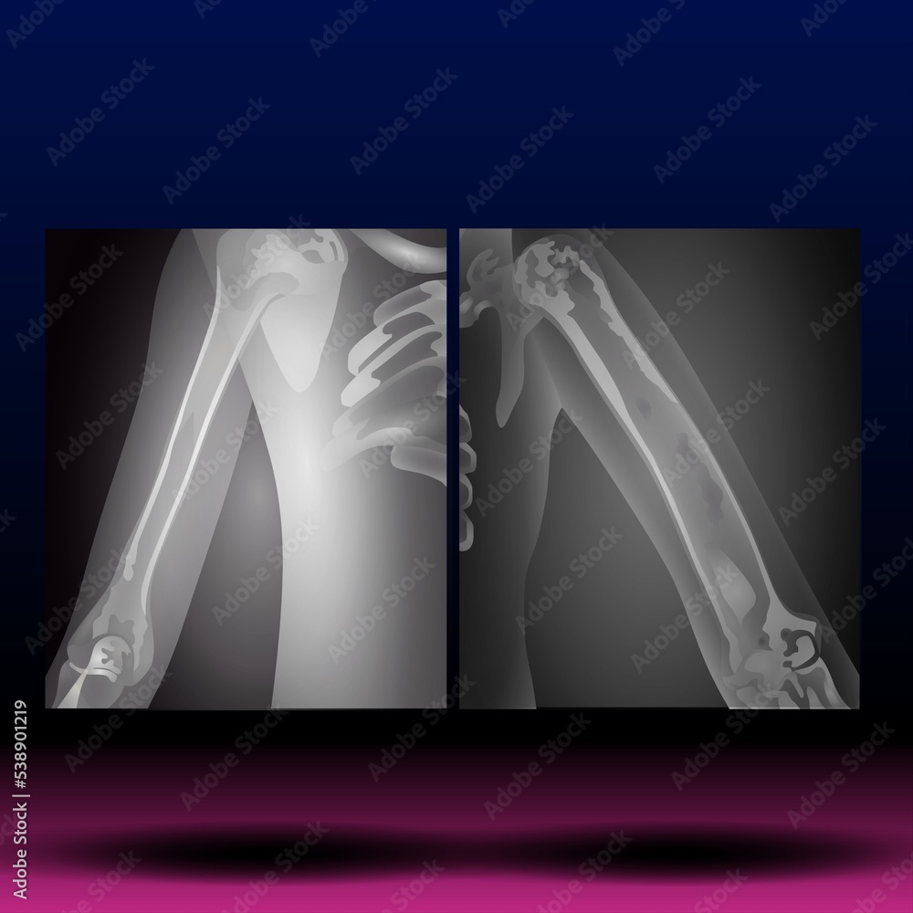 XRay of Hand Upper Limb Fla source file available The upper limb is divided into three