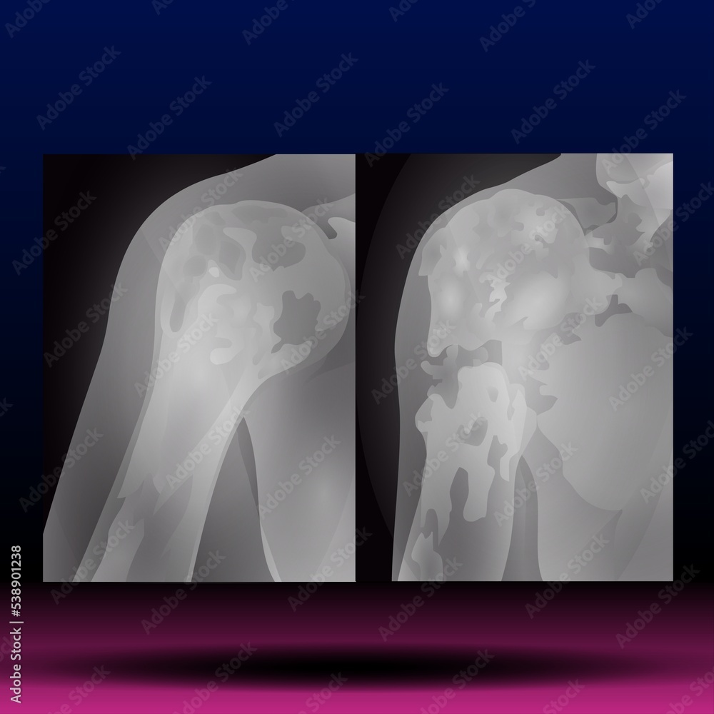 XRay of Shoulder Fla source file available xray images of the shoulder joint modified