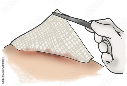 Wound care nursing clipart of bandage dressing change in comic style on transparent background