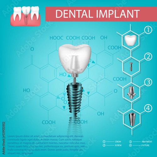 Vector realistic tooth. Structural elements of a dental implant. Infographic for medical poster.