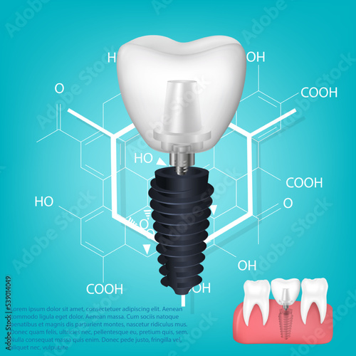 Vector realistic tooth. Structural elements of a dental implant. Infographic for medical poster.