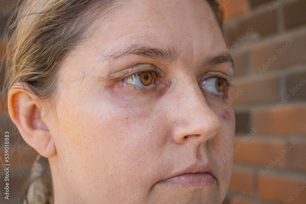 Double Eyelid Surgery, Eyes Surgery Recover Period, immediately after