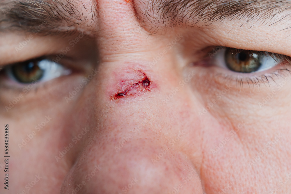 Fototapeta premium close-up. bloody abrasion on the bridge of the nose of a man after a blow. 