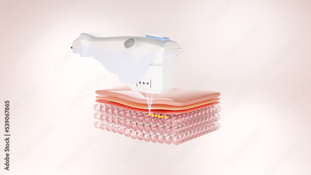 Hifu laser treatment shot through skin cell to SMAS layer to revitalize collagen and elastin under skin. wrinkle treatment by laser concept. 3D rendering. Hifu laser treatment shot through skin cell to SMAS layer to revitalize collagen and elastin under skin. wrinkle treatment by laser concept. 3D rendering.