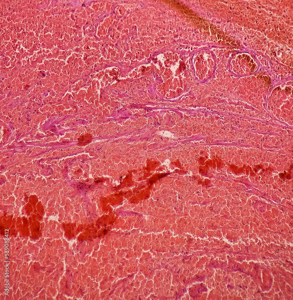Ovarian cyst Haemorrhagic cyst. Microscopic show ovarian cyst wall of