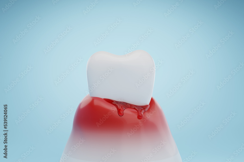 Bleeding gums and gum disease. Dental health and gingivitis concept. 3D