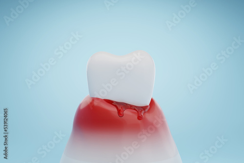 Bleeding gums and gum disease. Dental health and gingivitis concept. 3D rendering.