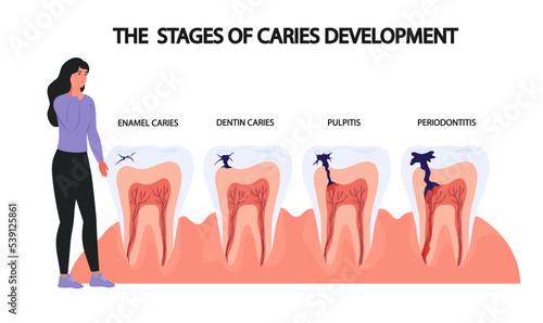 Caries development stages. Dentistry concept. Infographics. Tooth decay. Dental service. Banner, poster. Sick tooth. Patient girl with aching tooth. Flat vector illustration