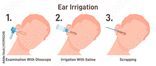 ENT doctor irrigate ears. Doctor checking ear canals, removing