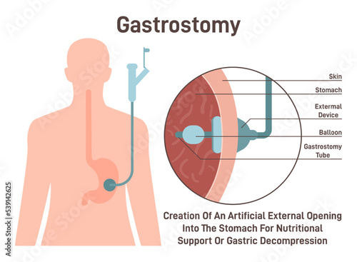 Gastrostomy. Gastric inserted feeding tube, food nutritions injecting