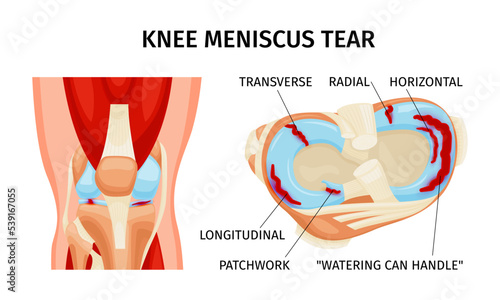 Knee Meniscus Tear Infographics photo