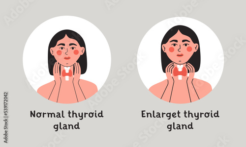 Normal and enlarget thyroid gland. Woman showing thyroid gland on her neck. Endocrinology system symbol, organ responsible for hormone production. Flat vector isolated illustration