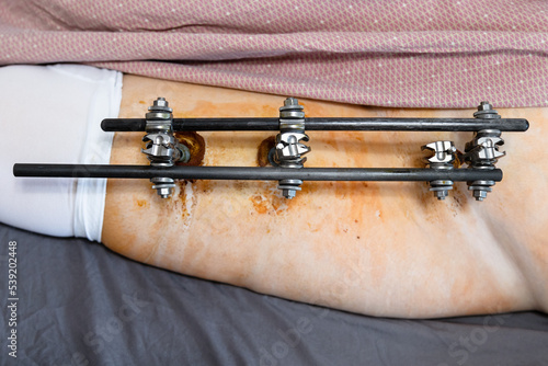 top view of external fixation device on hip and pelvic in patient with pelvic fracture (focus on the upper rods)