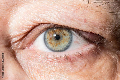 sore eye with thickening on eyelid from chalazion close up photo
