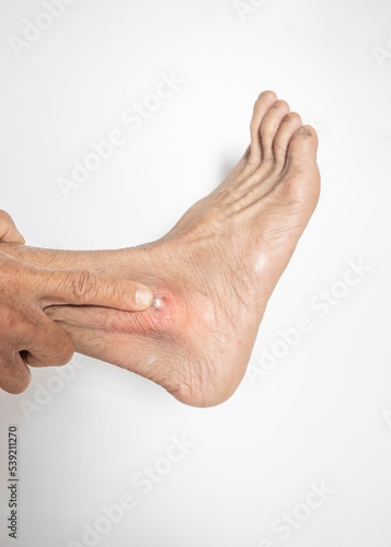 Skin blisters that are ulcerated on the feet of an elderly person photo
