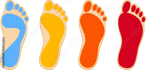 Stages of flat feet photo