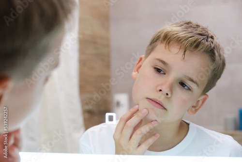 Teenager irritated by dry unhealthy skin  worried about problems with his face.