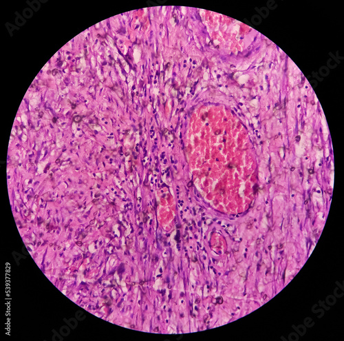 Testis biopsy, testicular infarction, disease of male genital organs, show testicular tissue, reveals features of infarction. testicle cancer. photo