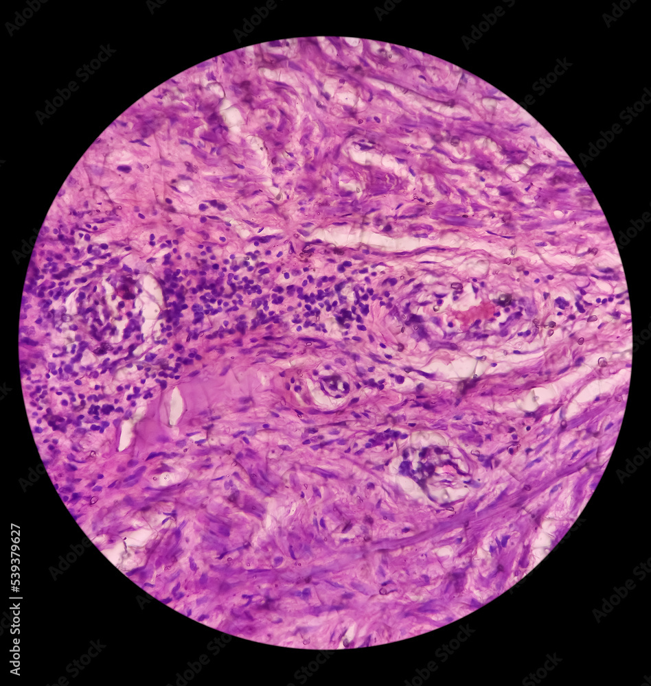 Testis biopsy, testicular infarction, disease of male genital organs, show testicular tissue, reveals features of infarction. testicle cancer. Testis biopsy, testicular infarction, disease of male genital organs, show testicular tissue, reveals features of infarction. testicle cancer.