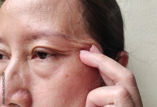 Portrait showing the fingers touching the flabbiness adipose sagging skin, wrinkles and ptosis beside the eyelid, Flabby skin and dark spots on the face of woman's, health care and beauty concept.