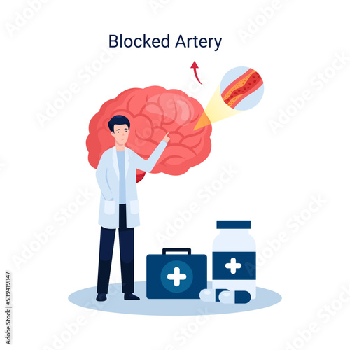 Ischemic stroke disease concept illustration, blocked artery